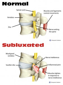 Subluxation