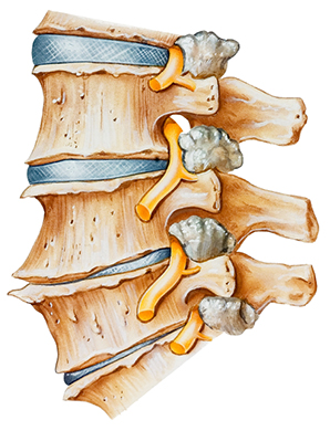 Degenerative Disc Disease